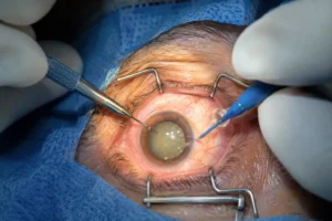 Consultant ophthalmologist Mr Mohamed Mohyudin examining a patient's eye using a slit lamp at The Eye Dr Clinic, Elland, Yorkshire