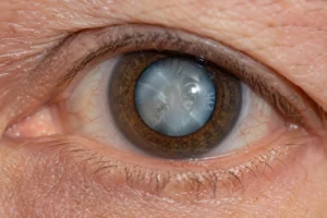Close-up of a human eye with a visible cataract showing cloudy lens opacity behind the pupil